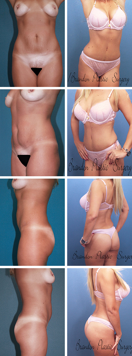 24 y/O Hourglass body makeover with circumferential Vaser Lipo sculpture and Butt enhancement South Tampa Tummy Tuck