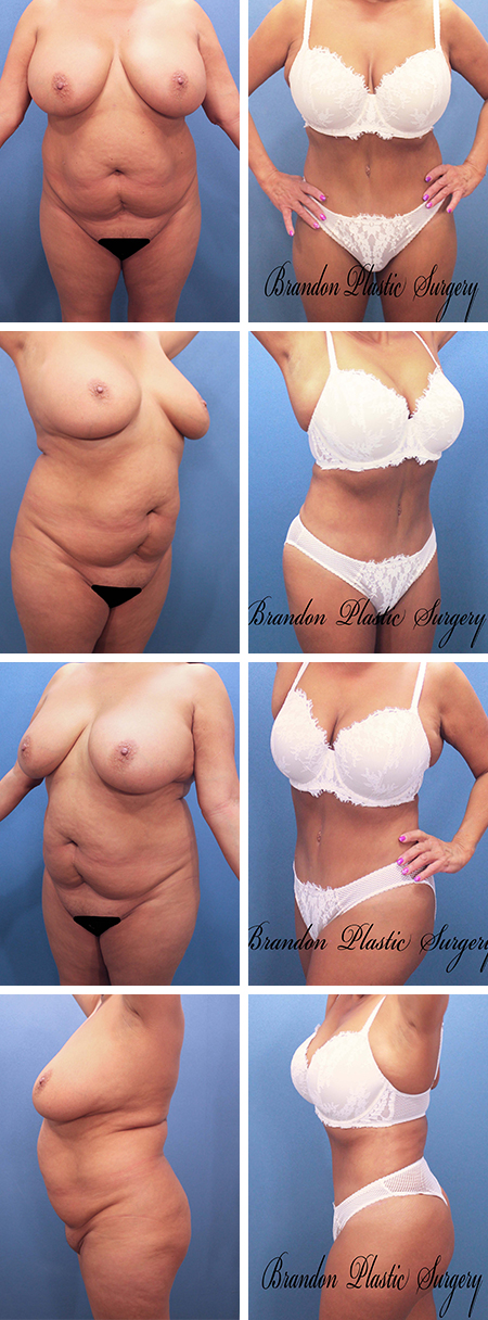33 y/o Hourglass Tummy Tuck Citrus Park Fl with corset waist narrowing and Liposuction contouring of flanks thighs and back .