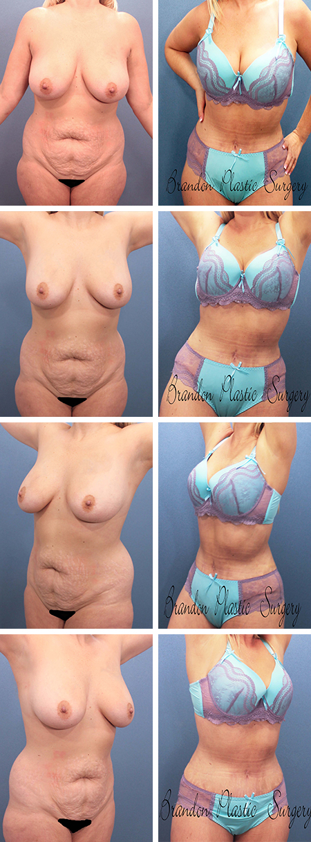 42 y/o Tummy Tuck Manatee County with Vaser 360 degree lipo sculpting and abdominal diastasis repair.
