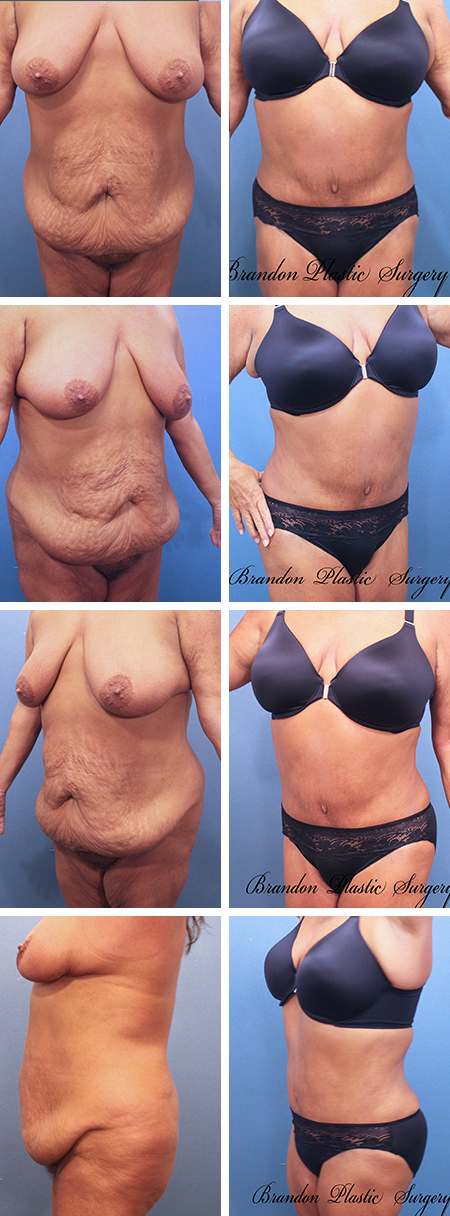 53 y/o MWL with sagging abdominal panniculus . Results following a Hourglass Tummy Tuck Pinellis Park Feather Sound Florida .