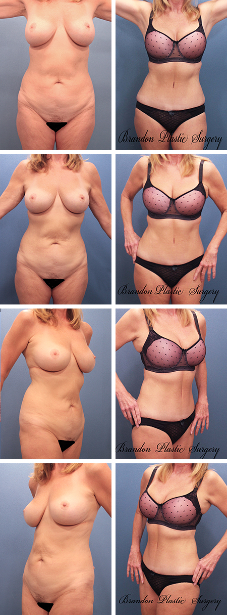 31 y/o Diastasas Recti with protuberant abdomen corrected with Vaser Lipo sculpture and a Hourglass Tummy Tuck Dunedin Palm Harbor Florida