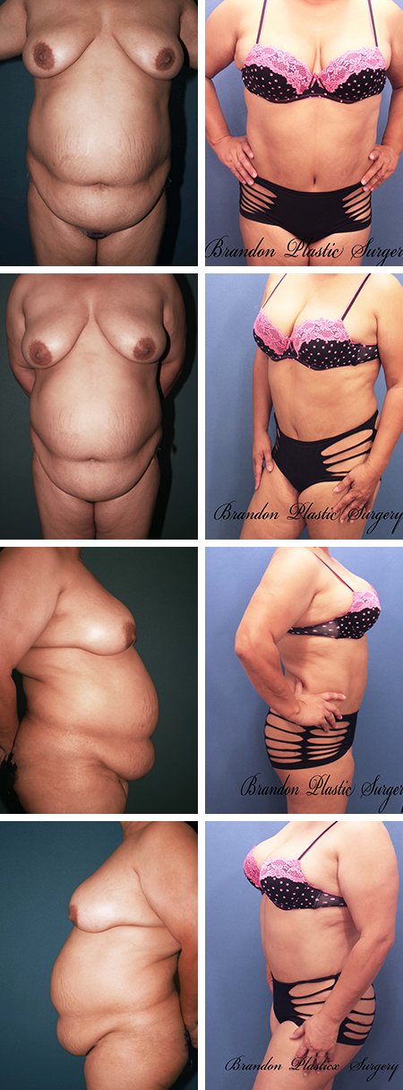 54 y/o Distended abdominal wall with ptotic belly roll corrected with Hourglass Tummy Tuck Lake Wales Avon Park Florida
