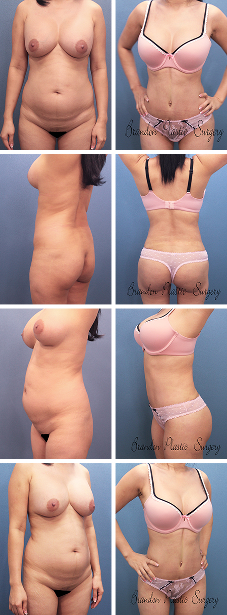 35 y/o Hourglass Lipo abdominoplasty technique of Vaser lipo sculpture and butt enhancement to create a totally new body silhouette Tummy Tuck Largo Seminole Fl