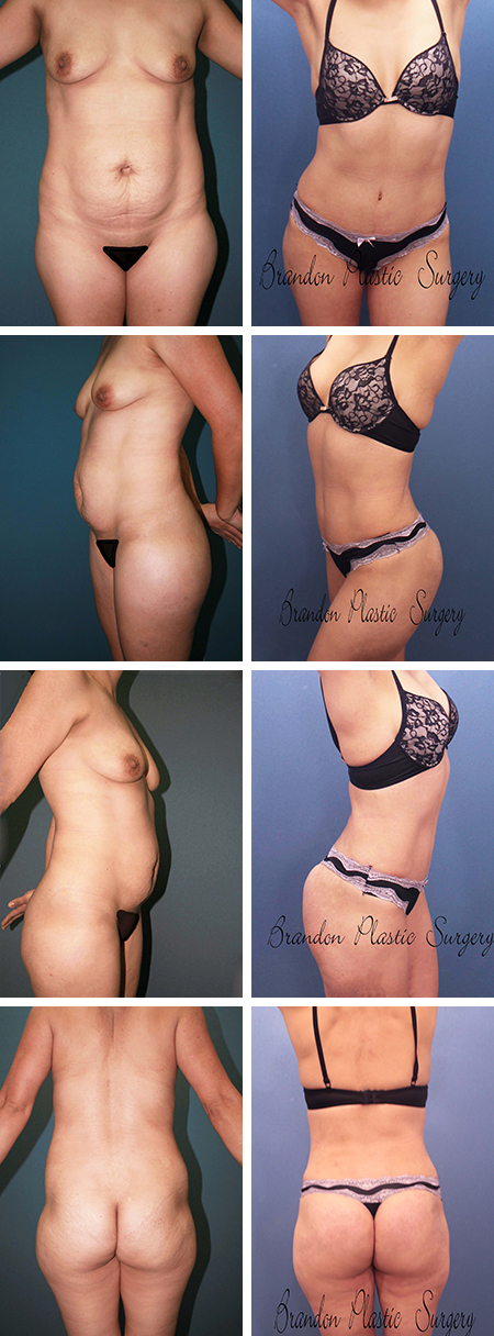 34 y/o Tummy Tuck Riverview Fl with hourglass silhouette from total body sculpting , butt enhancement and repair of umbilical hernia .