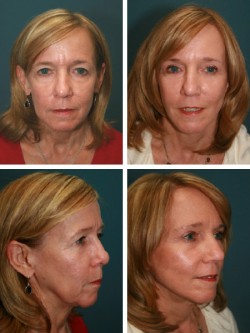 62 años - Tampa, Fl. Estiramiento facial con restauración de volumen de cara media SMAS plegada, estiramiento del cuello con avance platismal y rejuvenecimiento de grasa autólogo.