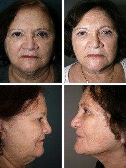 73 años -Tampa, FL. Resultados de estiramiento facial logrados con la reestructuración de la eslinga muscular del cuello, el avance de rotación de elevación SMAS y la restauración de la cara media con suspensión facial y anclaje.