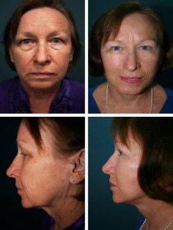65 year old, Lakeland Winter Haven, FL. with zygomatic, orbital and cheek enhancement by muscular rotation advancement and fat re-positioning. 