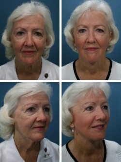 Polk City Auburndale, FL, de 73 años. Estiramiento facial con restauración volumétrica de la plenitud de la cara media y atención y suavizado de la banda del cuello platismal.