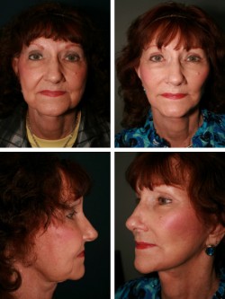 72 year old Lakeland Plant City, FL. Facelift with jowl removal, neck suspension and midface/ cheek rejuvenation with soft tissue facial elevation and superior anchoring. 
