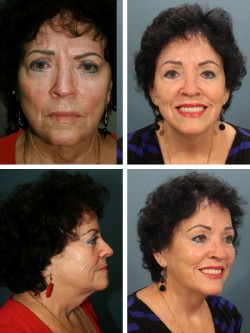 Lifting facial. Dade City Zepherhills, Florida