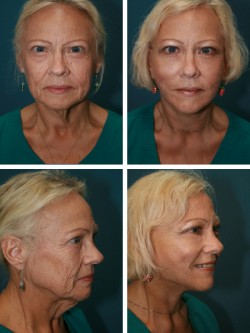 Facelift Brandon Lithia, FL. patient