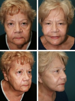 Valrico Brandon, Florida. Facelift results