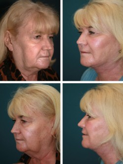 64 year old -Facelift Brandon New Tampa, Fl with prominent jowls and neck redundancy requiring extensive Liposculpture , neck suspension and SMAS advancement with upward rotation .