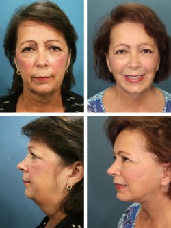 36 year old - Facelift, Tampa Bay, FL. Achieved with full SMAS rotation advancement liposculpture with neck contouring with muscle sling corset tightening technique. 