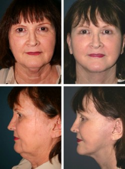 63 y/o Facelift Gibsonton Tampa Bay Florida achieved with full SMAS rotation advancement lipo sculpture with neck contouring with muscle sling corset tightening technique. 