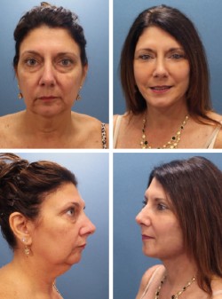 Lifting Facial Paciente Seffner Florida