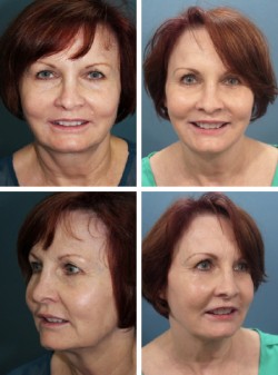 Brandon Fl facelift patient