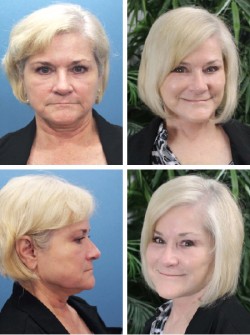 64 y/o Facelift Thonotosassa Fl with cheek enhancement by fat transfer , jowl removal and neck firming .