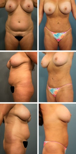 brandon florida liposuction surgery patient