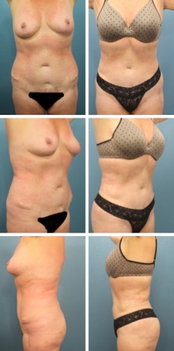 Liposucción con Transferencia de Grasa en Tampa