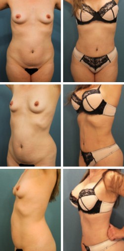 37 year old- Tampa. Liposuction patient