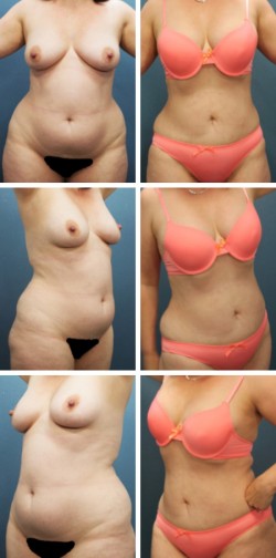Liposuction in Lithia- Brandon, Florida patient