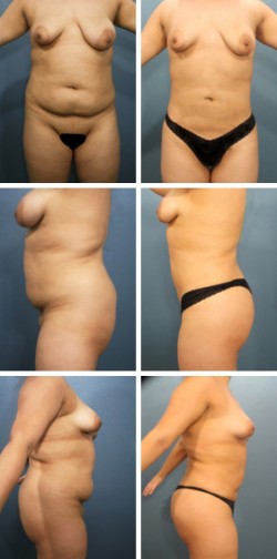 Tampa. Liposuction & Brazilian Butt Lift patient