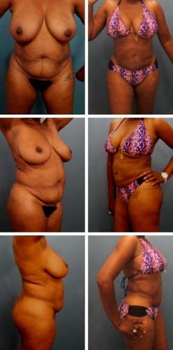 lakeland liposuction patient