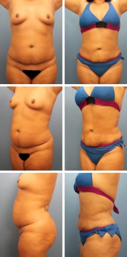 Tampa Bay. FL. liposuction.