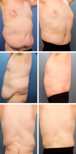 Abdominoplastia masculina New Tampa Wesley Chapel Fl