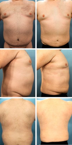 Ginecomatia masculina y reducción abdominal Sun City Apollo Baech Fl
