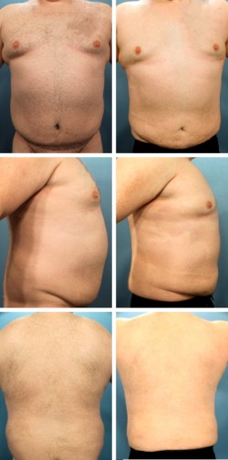 Male Gynecomatia and Abdominal reduction Sun City Apollo Baech Fl