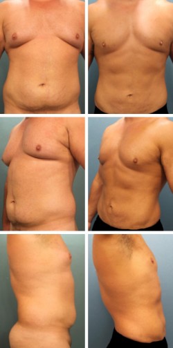 male breast reduction in Lakeland Florida 