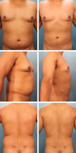 male breast reduction in Sarasota Fl