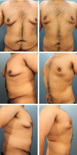 Bartow Mulberry Fl Male Breast and waist reduction patient