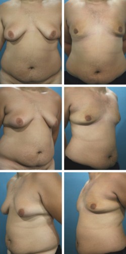 Gynecomastia and Waist Reduction in Plant City Fl