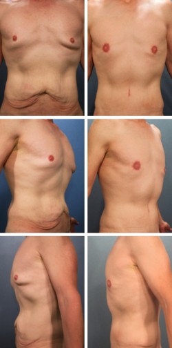 Male Breast Reduction Riverview Florida