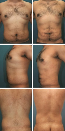 Zephyrhills Dade City Florida male breast reduction patient