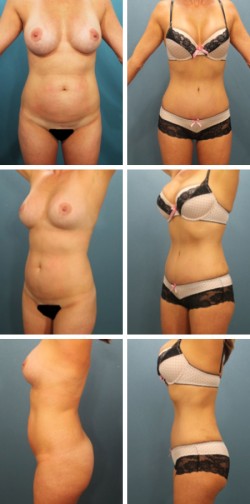  Tummy Tuck Ruskin Lithia Fl with Liposuction