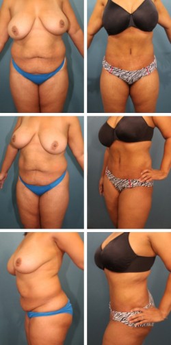  Temple Terrace Thonotossasa Fl tummy tuck patient