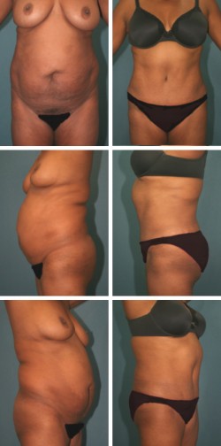 Abdominoplastia con Lipo Tuck Sebring Avon Park Fl Lipo