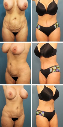 Tummy Tuck Mulberry Fort Meade Fl