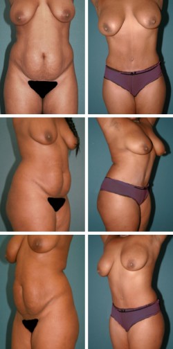 Tummy Tuck Wesley Chapel New Tampa, FL patient