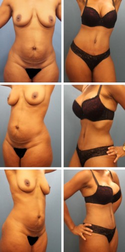 Paciente con abdominoplastia en Tampa, FL