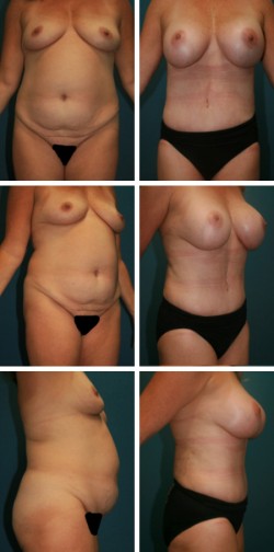 Tummy Tuck in Bartow Fl with Breast enchancement