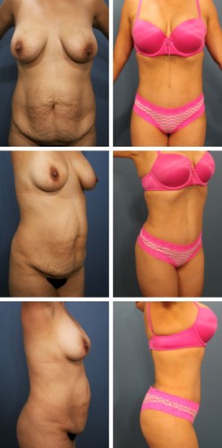 Abdominoplastia Apollo Beach Sun City Fl