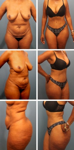 Abdominoplastia en paciente de Clearwater Fl