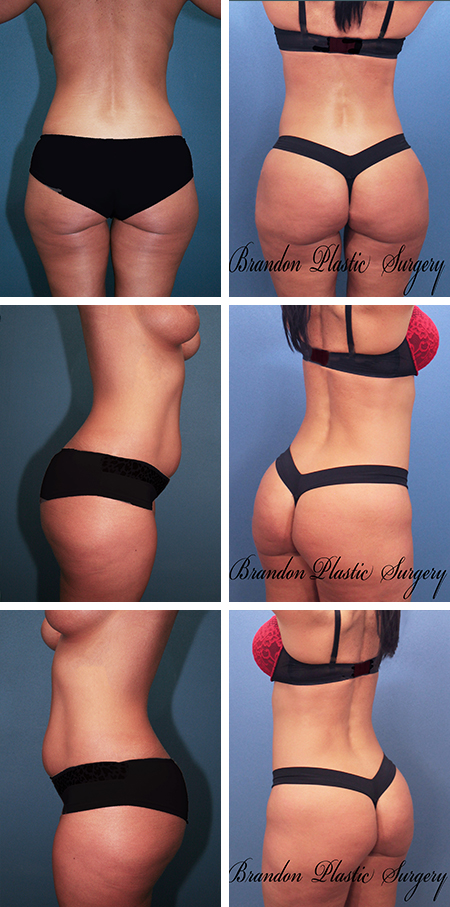 35 y/o Brazilian Butt Lift Ocala Florida with 650 cc of fat transfer