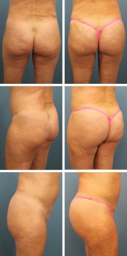 Haines city fl butt lift surgery patient