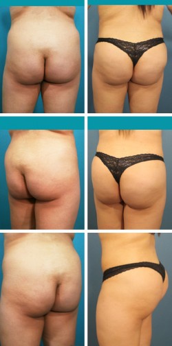 butt lift patient in wesley chapel florida